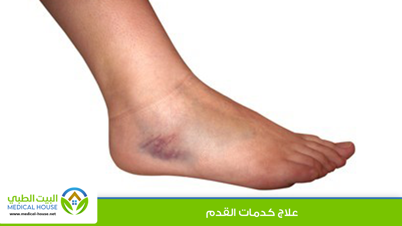 علاج كدمات القدم